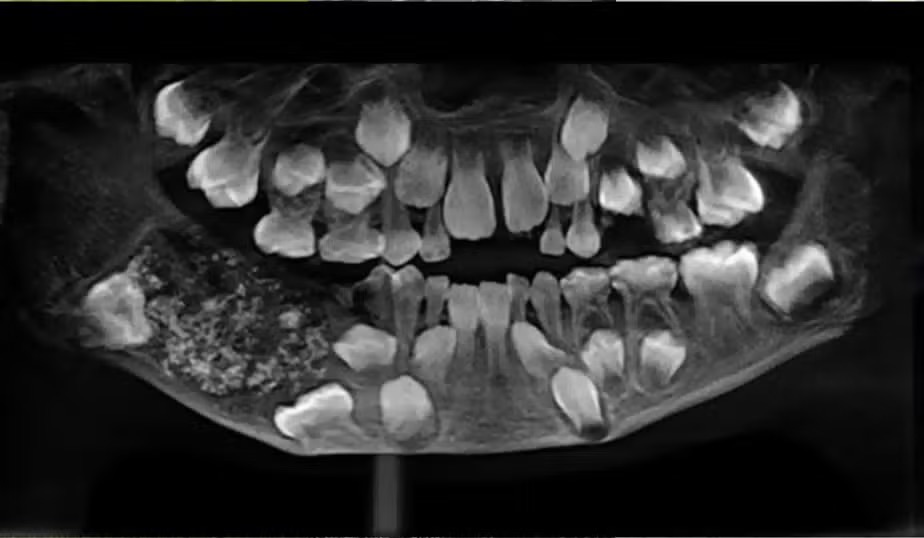 Insólito. Médicos encontraram 526 dentes dentro da boca de um menino de 7 anos