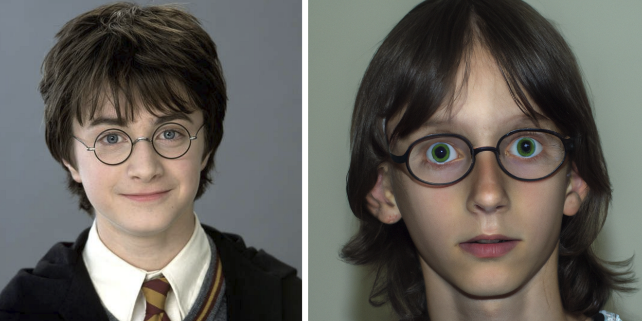 Homem recebe primeiro transplante de olho completo. Operação envolveu 140 profissionais de saúde