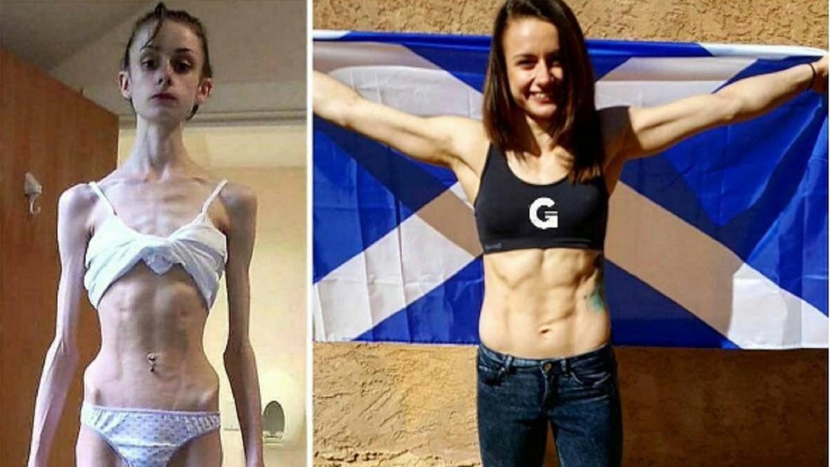 Antes e depois. A foto que está a chocar as redes sociais revela a brutalidade da anorexia