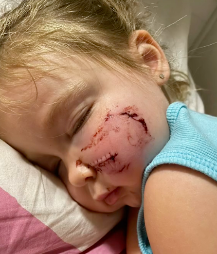 Mãe arrasada por recusar abandonar o cão da família que mordeu a filha na cara. Até o marido a deixou