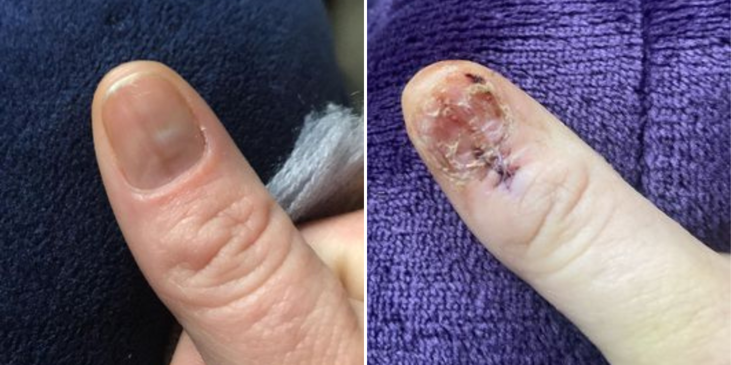Mulher vai à manicure e descobre que tem um cancro raro. “É possível que a esteticista tenha salvado a minha vida”