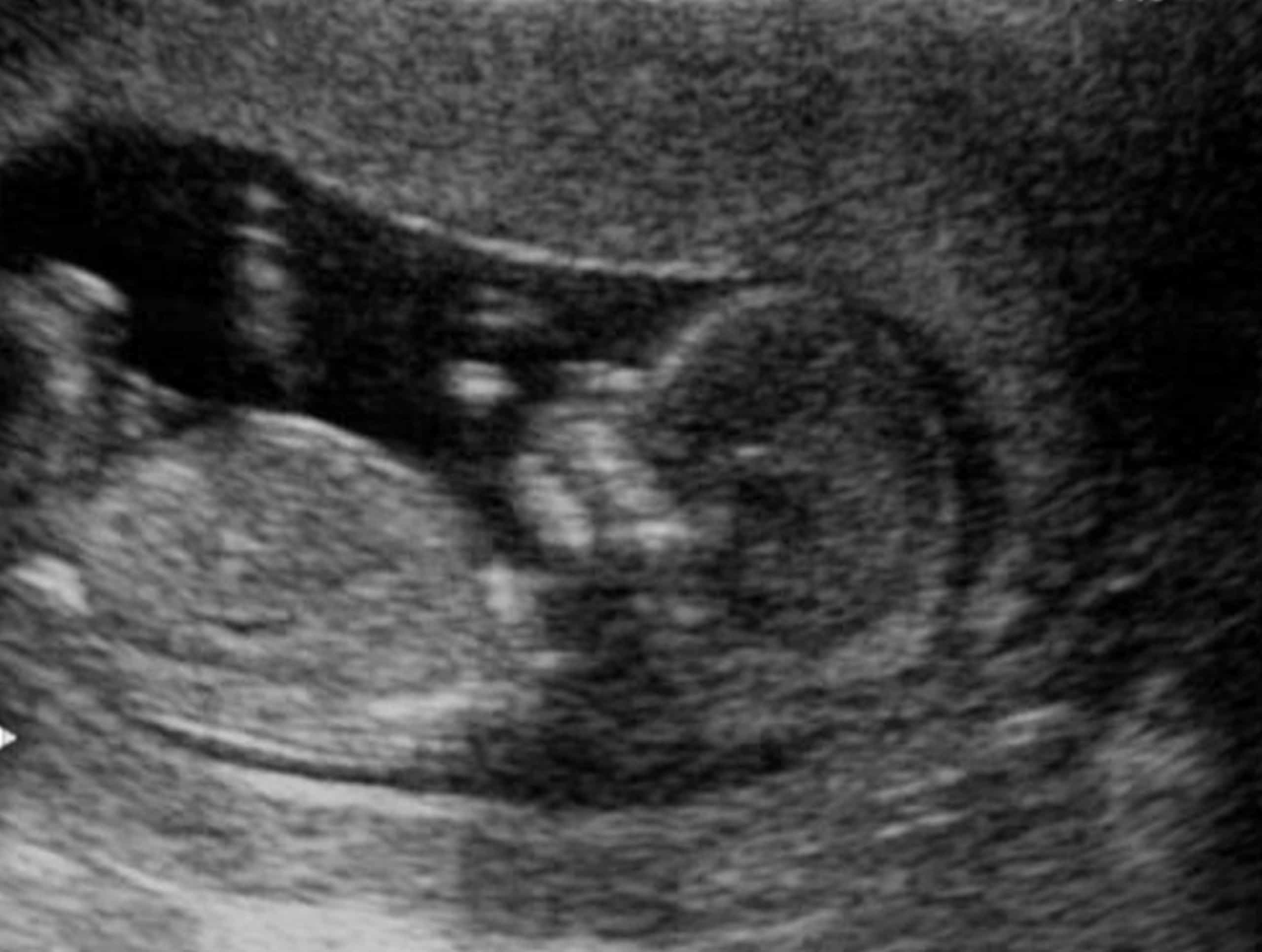 Ребенок на 13 неделе беременности УЗИ