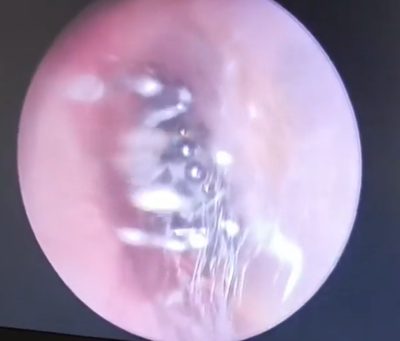 Médico descobre uma colónia de aranhas a viver dentro do ouvido de uma mulher