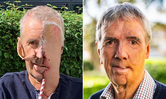 Homem ficou sem metade da cara depois de acidente. Uma prótese em 3D devolveu-lhe o rosto. Veja o antes e depois