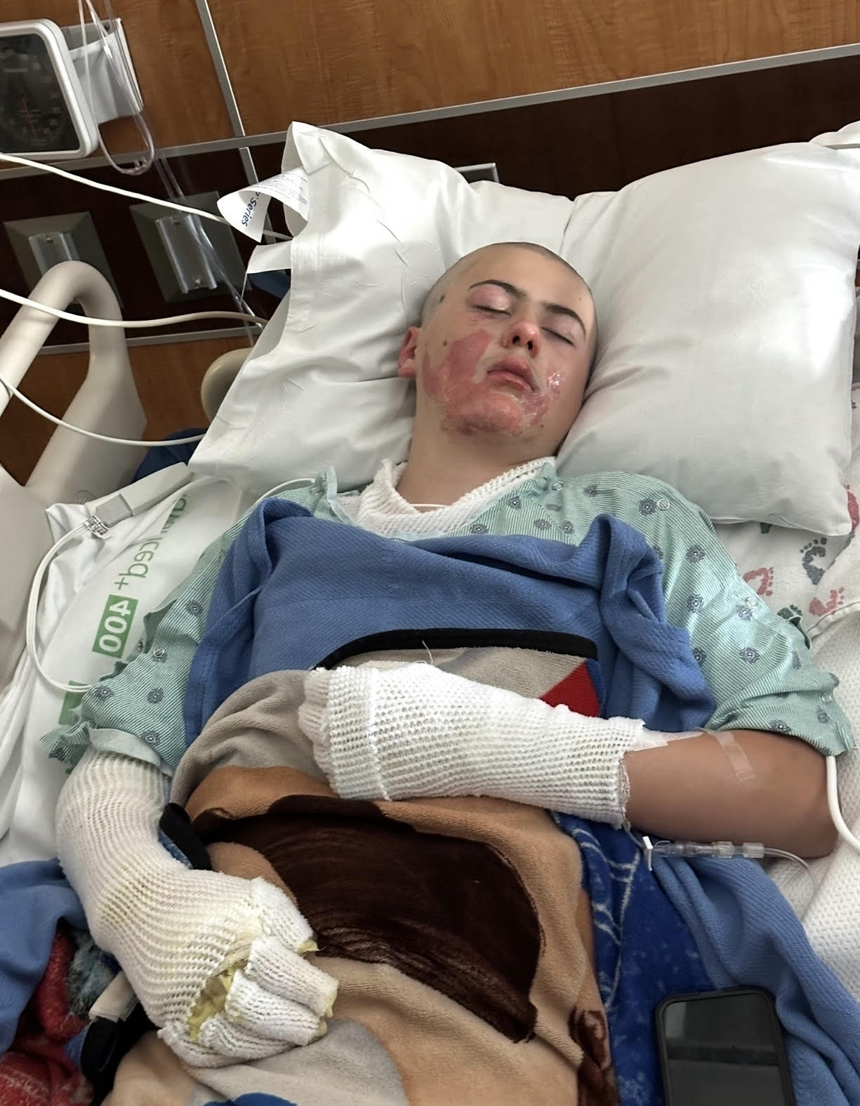 Criança de 12 anos tentou recriar um vídeo do TikTok. Acabou com 11% do corpo queimado