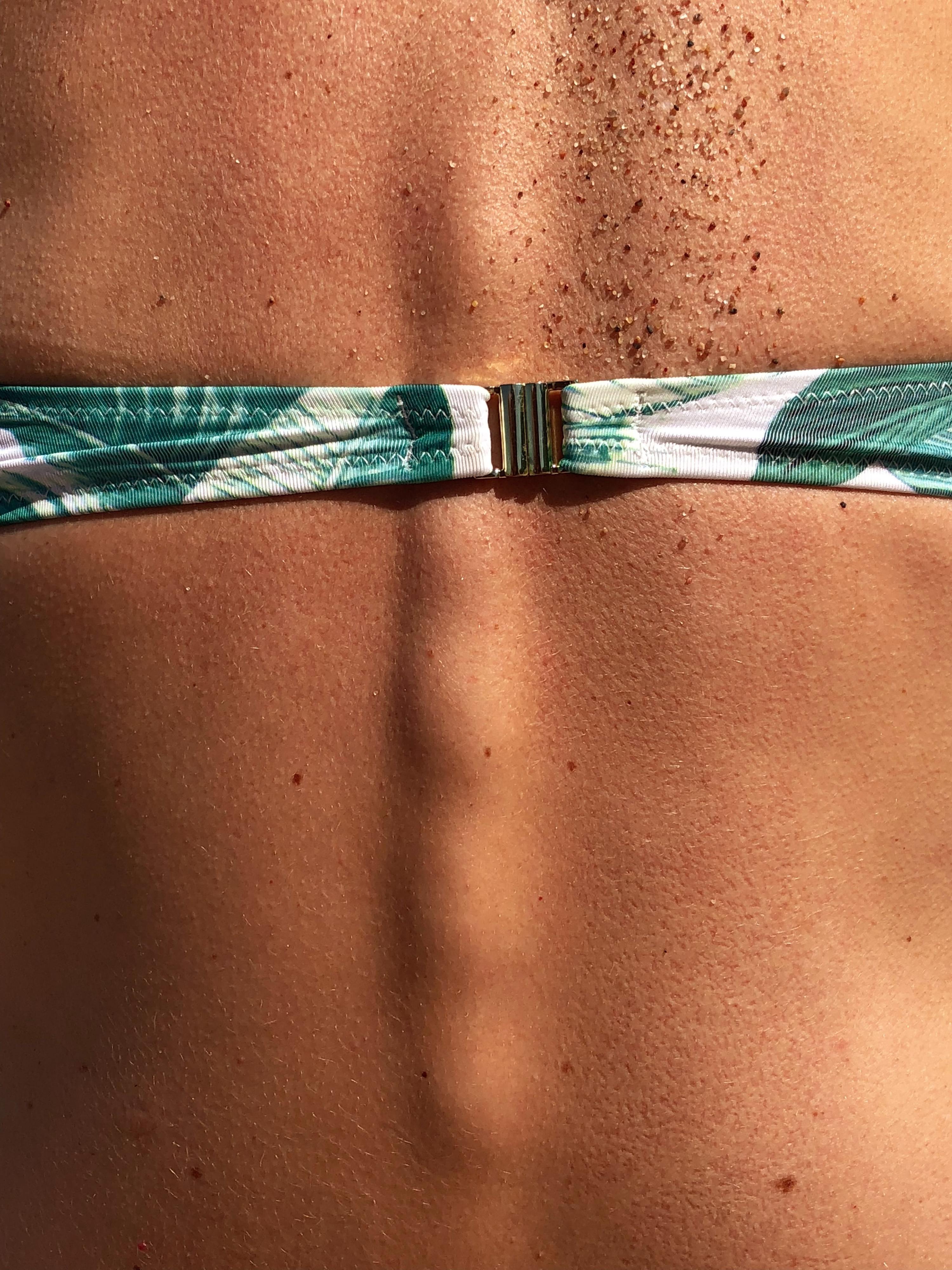 Escaldão. Quais os principais perigos e o que fazer em caso de queimadura solar