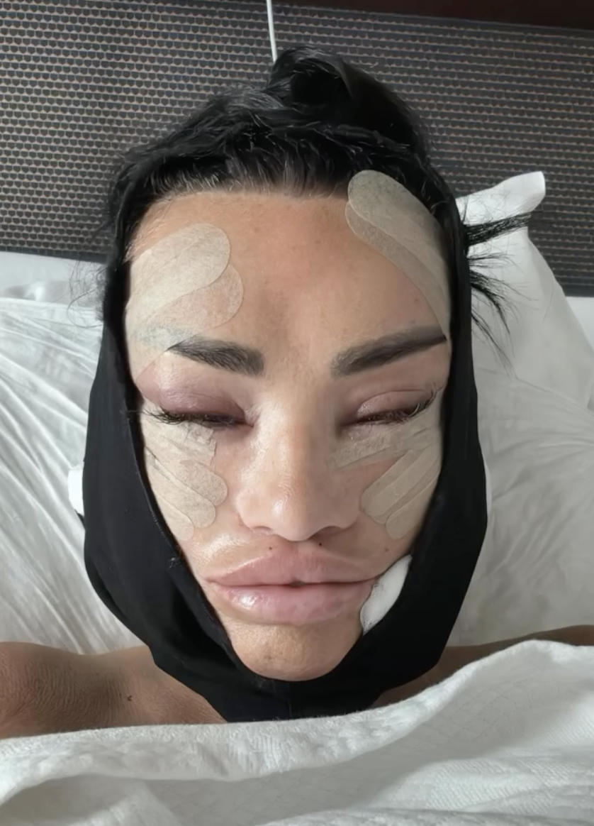 Katie Price partilha fotos chocantes de como ficou logo após um lifting facial. Veja como ficou depois