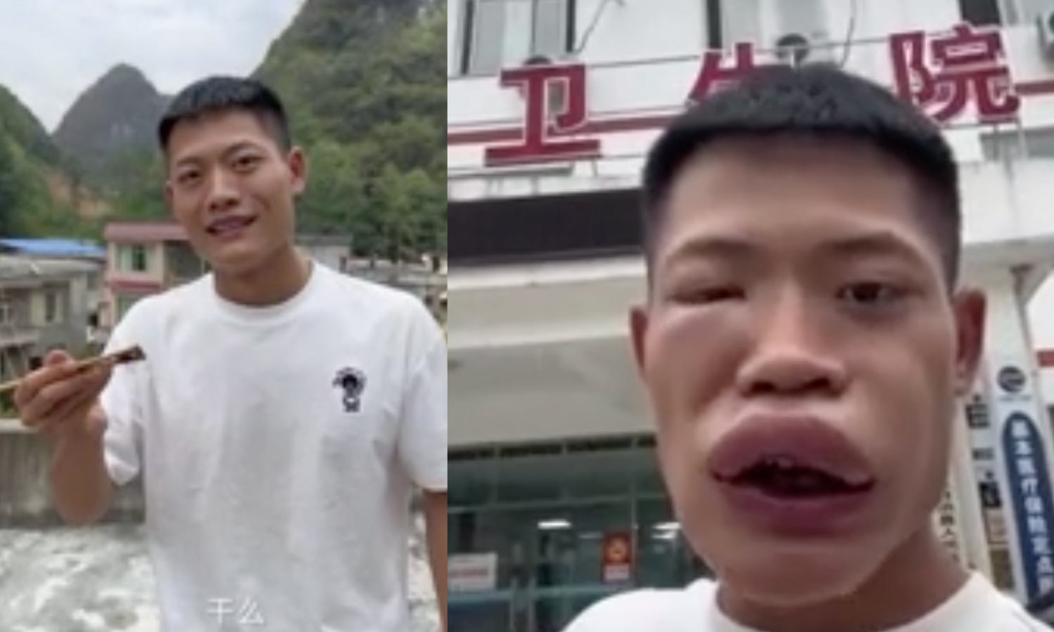 Influencer come uma vespa viva e acaba desfigurado