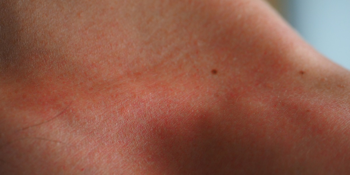 Aplica&ccedil;&atilde;o desenvolvida no Porto efetua rastreios de pele e avalia risco de melanoma