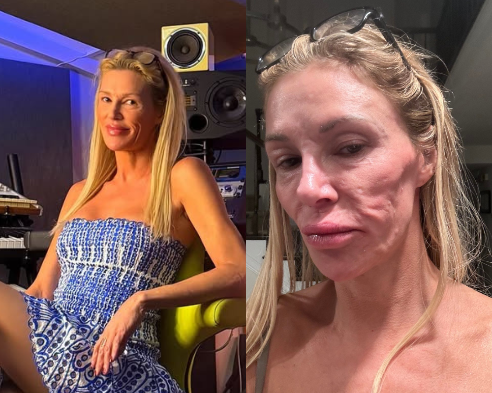 Antiga estrela de reality tv tem parasita na cara. Veja as imagens do antes e depois