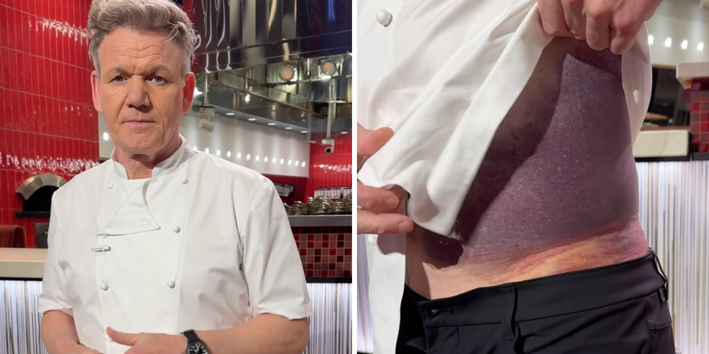Gordon Ramsay sofre grave acidente e mostra sequelas. “Sou um sortudo por estar aqui”