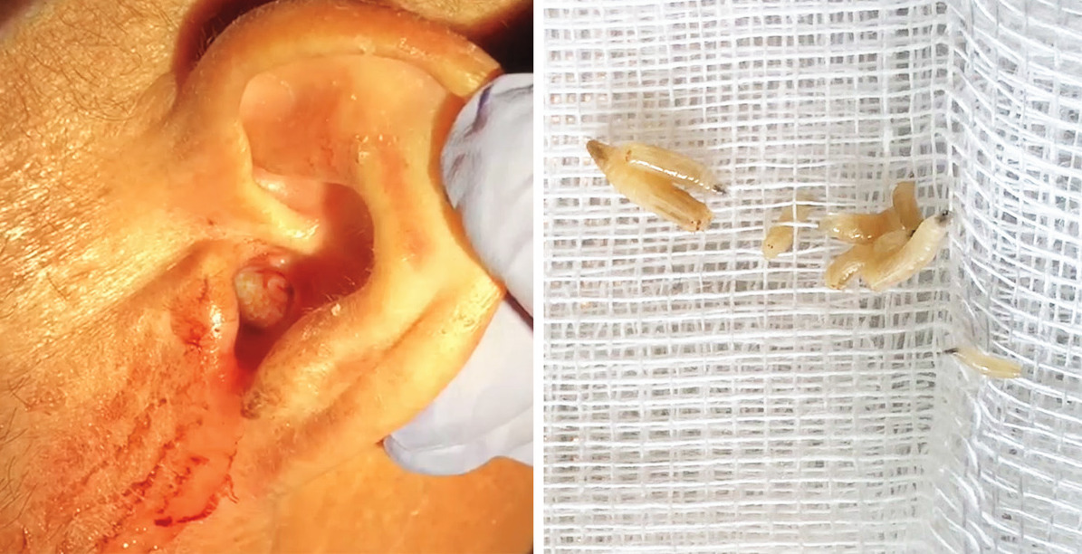 Homem dá entrada no hospital de Matosinhos com larvas carnívoras no ouvido