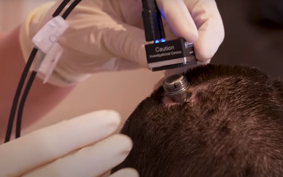 Implantes cerebrais com IA já estão a ajudar pessoas com paralisia a falarem (quase) normalmente