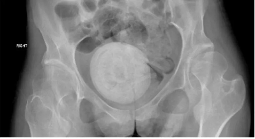 Mulher vai para o hospital com dores abdominais e médicos descobrem pedra na vagina