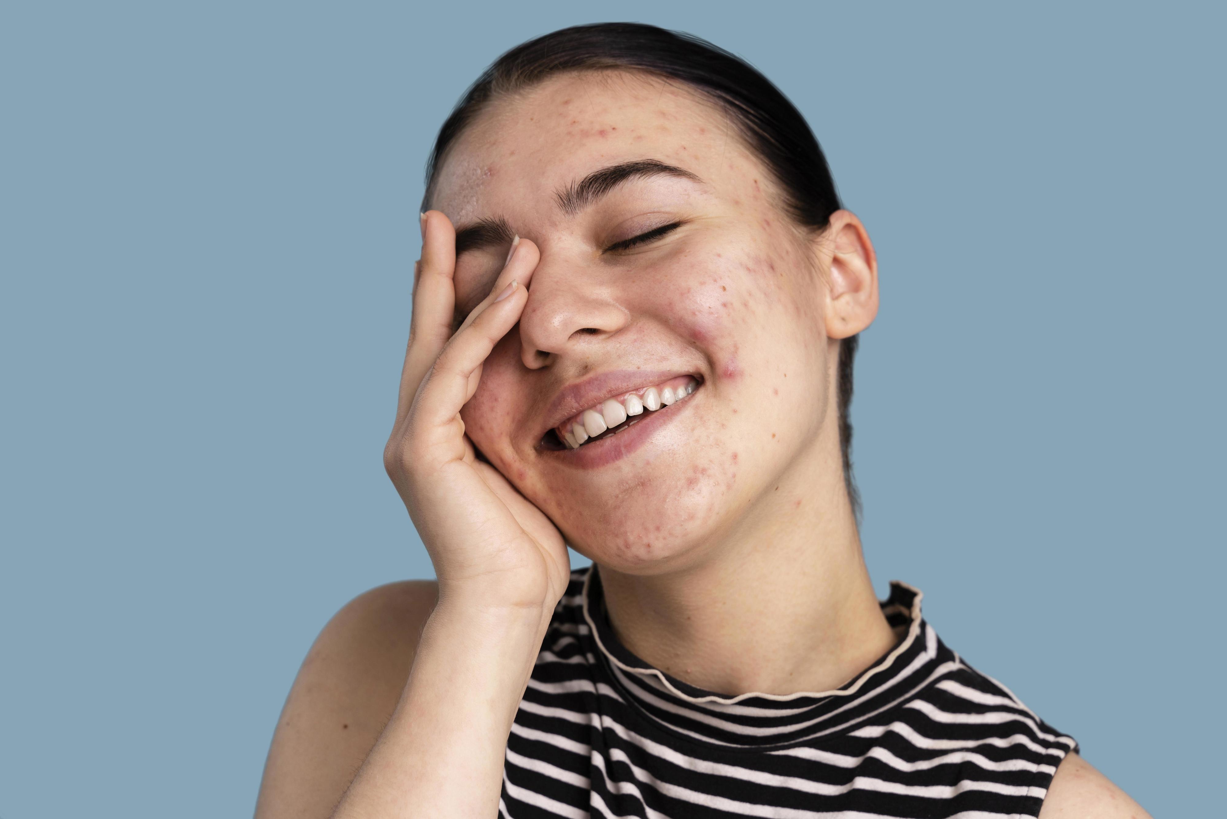 Biretix. Este é o novo melhor amigo de quem sofre com acne e pele oleosa