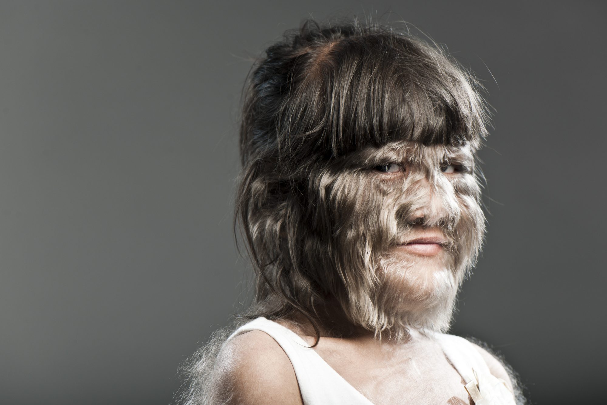 Esta é a jovem mais peluda do mundo. Sofreu bullying durante anos e agora encontrou o amor