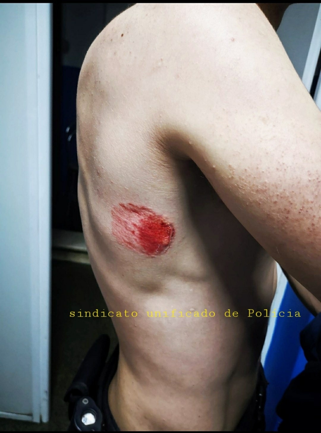 Agente da PSP é mordido por condutor alcoolizado e infetado com COVID-19