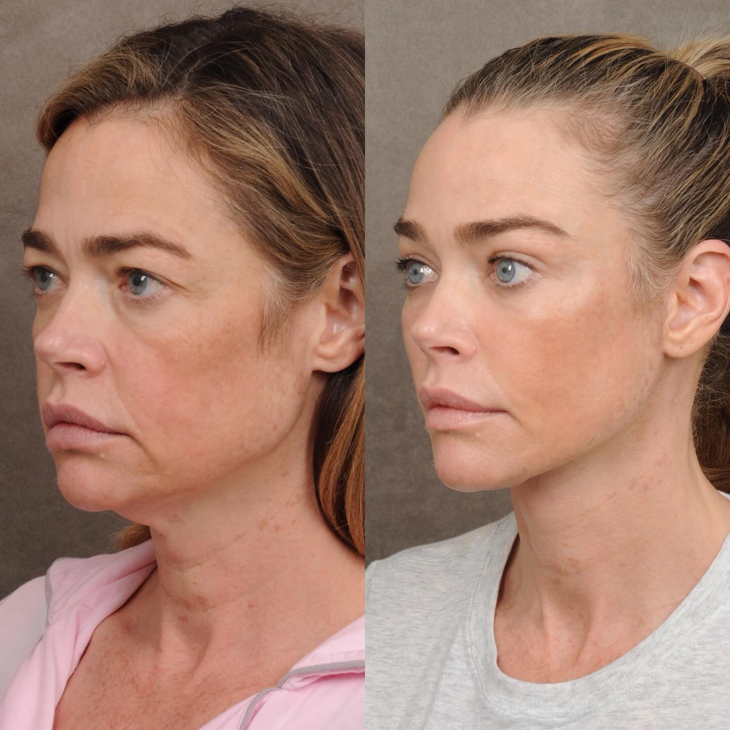 Denise Richards faz facelift aos 55 anos e admite que foi “a melhor coisa que podia ter feito”. Veja a diferença