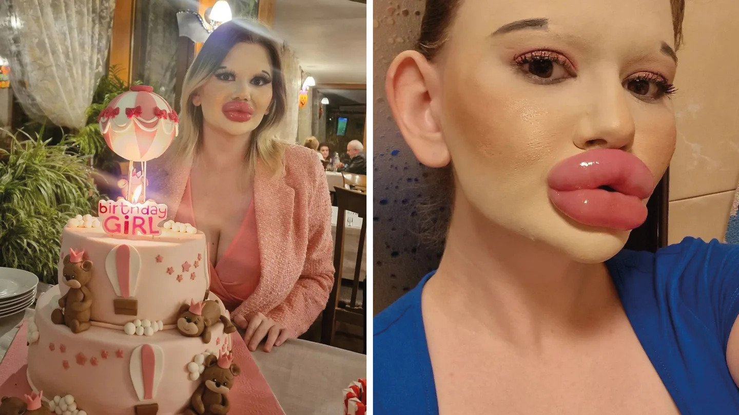 Mulher viciada em plásticas é alertada pelo médico de que corre risco de vida, mas garante: “Eu quero mais”