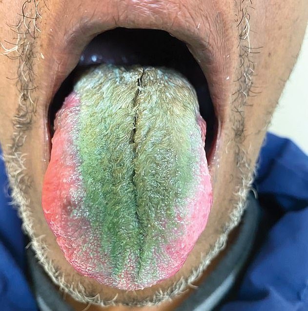 A língua deste homem ficou verde e peluda. Poderá ser uma reação rara a tabaco e antibióticos