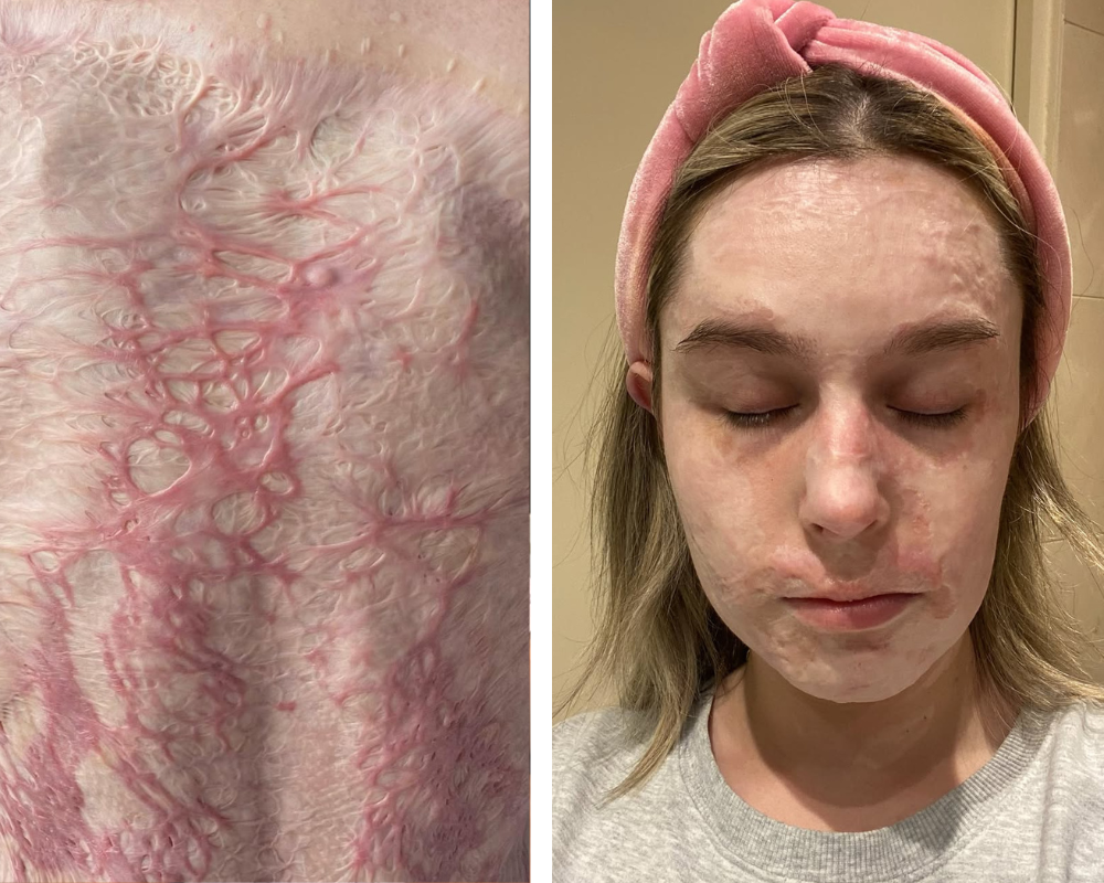 Jovem de 23 anos teve 8 dedos amputados e 70% do corpo queimado por causa de um vulcão. Veja o antes e depois