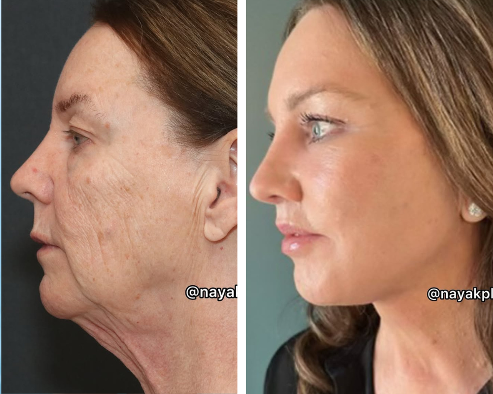 Perde 50 quilos, faz um lifting e ninguém acreditou que fosse a mesma. Veja o antes e depois