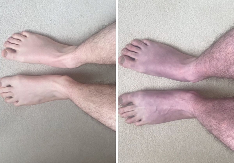 Homem que sofre de Covid longa fica com pernas azuis. É o mais recente sintoma associado à doença