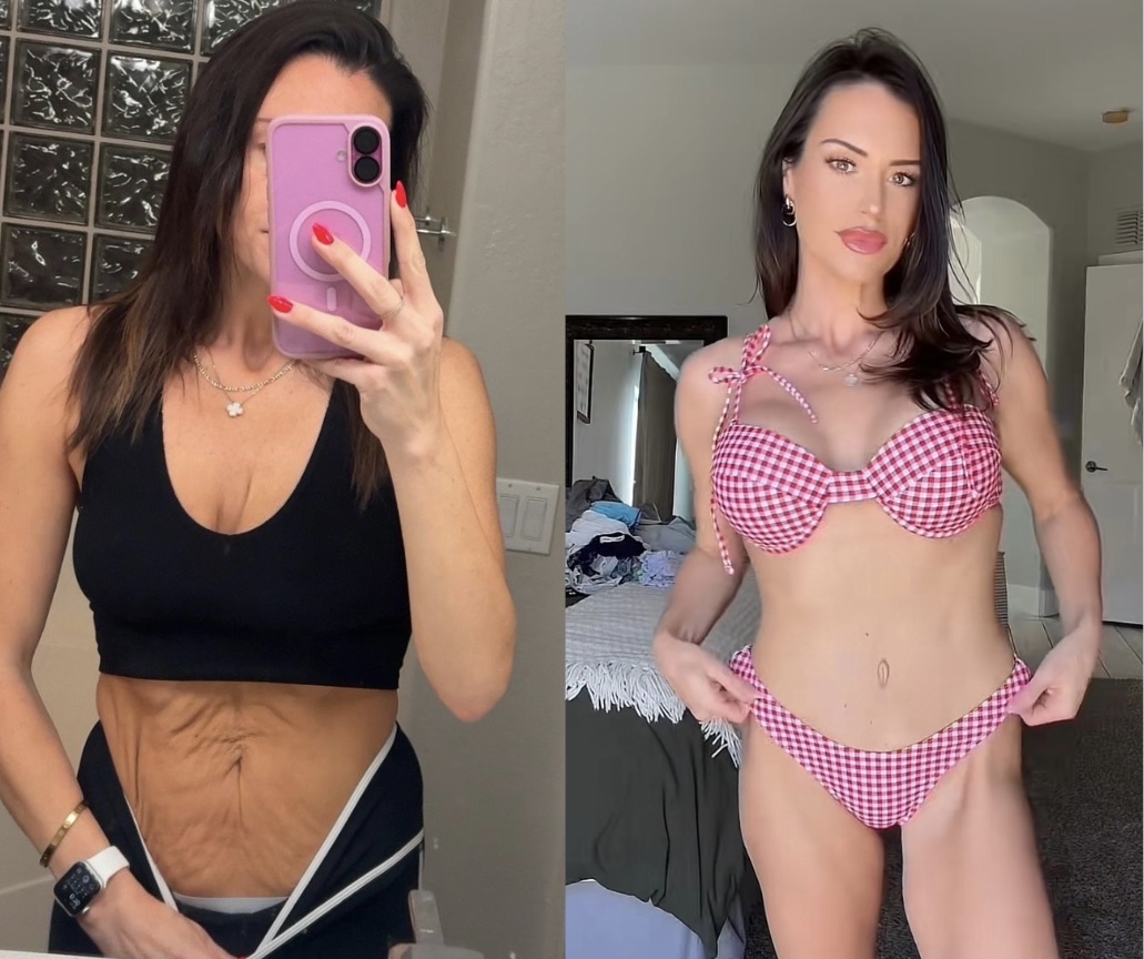 Veja o antes e depois desta mãe de 35 anos que viajou até à Turquia para uma “mommy makeover”