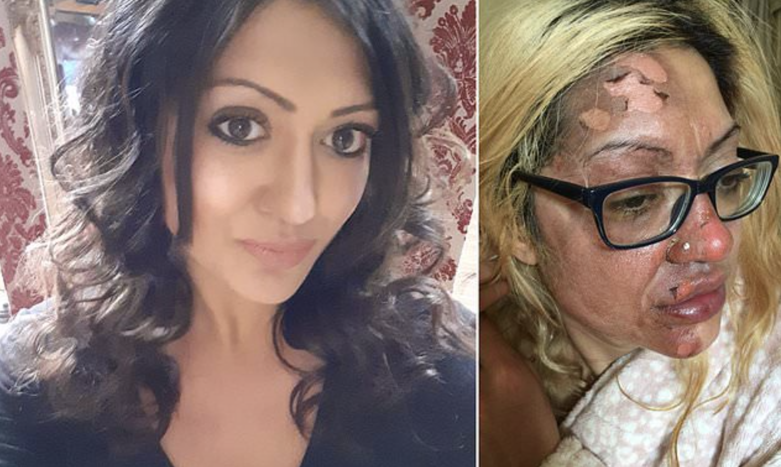 Mulher fica com metade da cara queimada ao tentar cozer um ovo no microondas e filmar para o TikTok