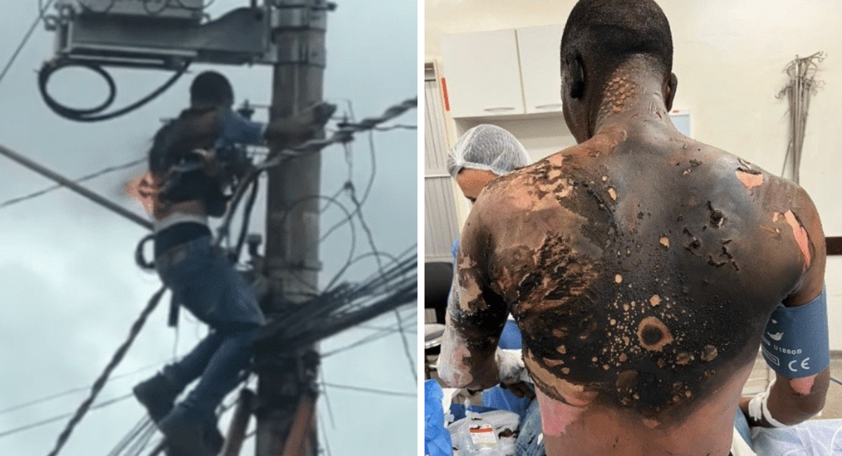 Homem leva choque elétrico e fica com corpo queimado e sem orelha. “Morri por alguns segundos”