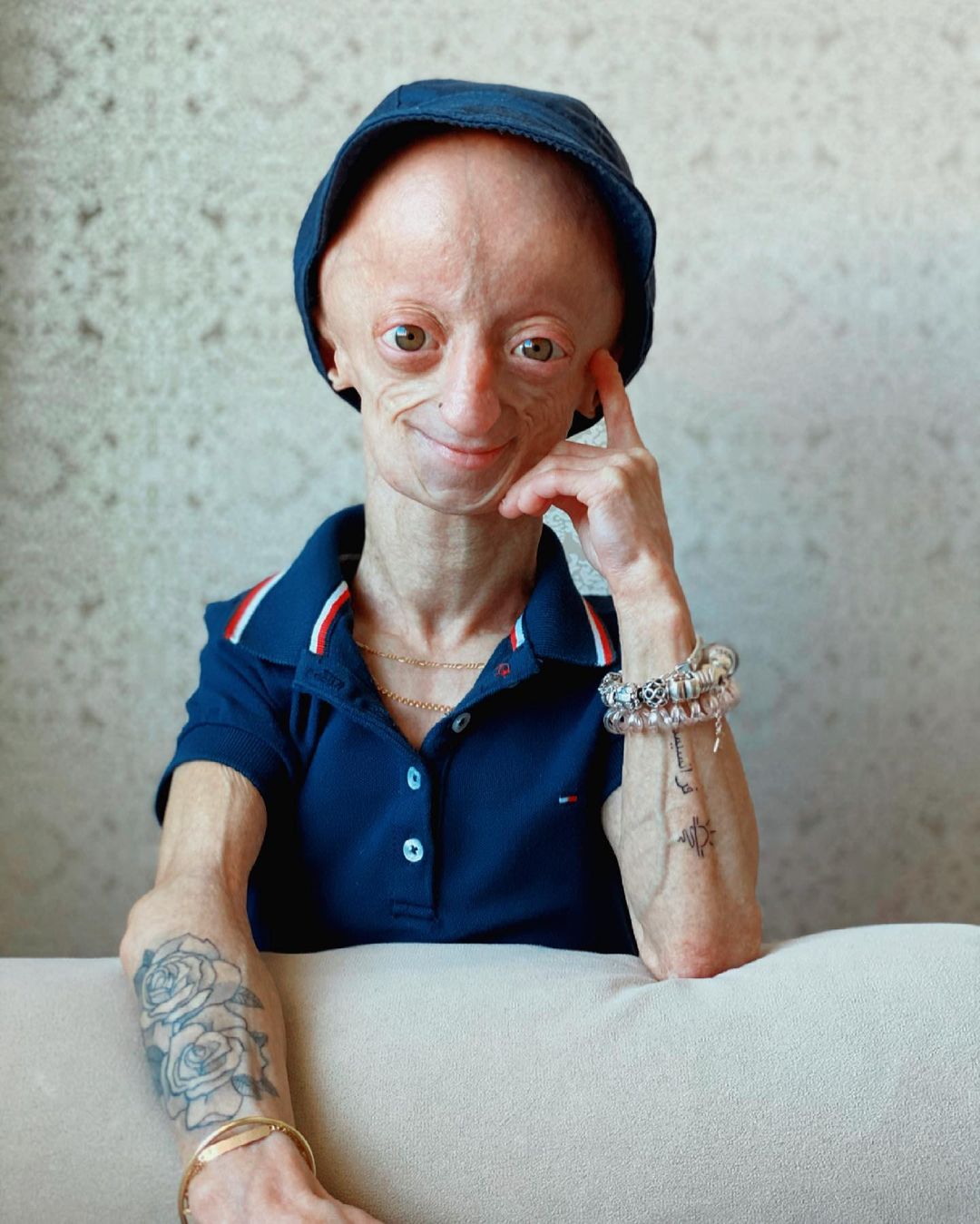 Morreu Cláudia Amaral, a TikToker que sofria de uma condição rara que a envelhecia muito depressa