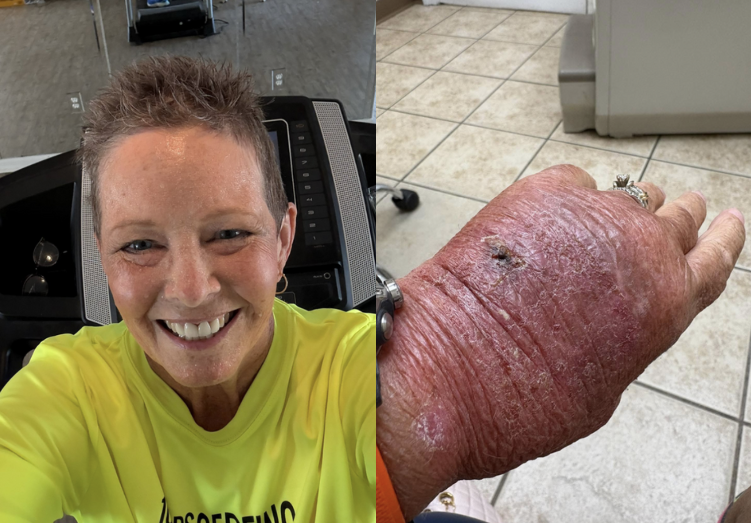 Mulher sofre simples corte de papel e fica com uma infeção brutal. Imagens são impressionantes