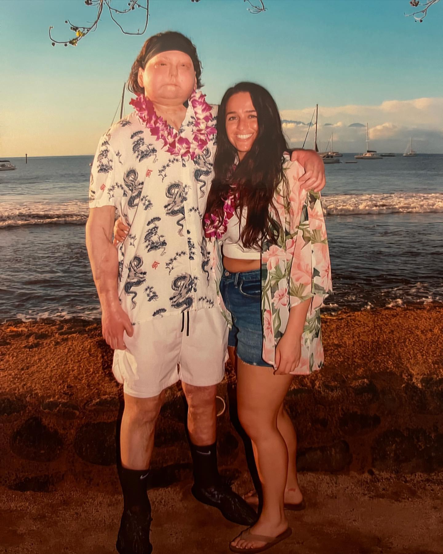 Perdeu o rosto e as duas mãos num acidente. Depois de um transplante de cara, encontrou o amor