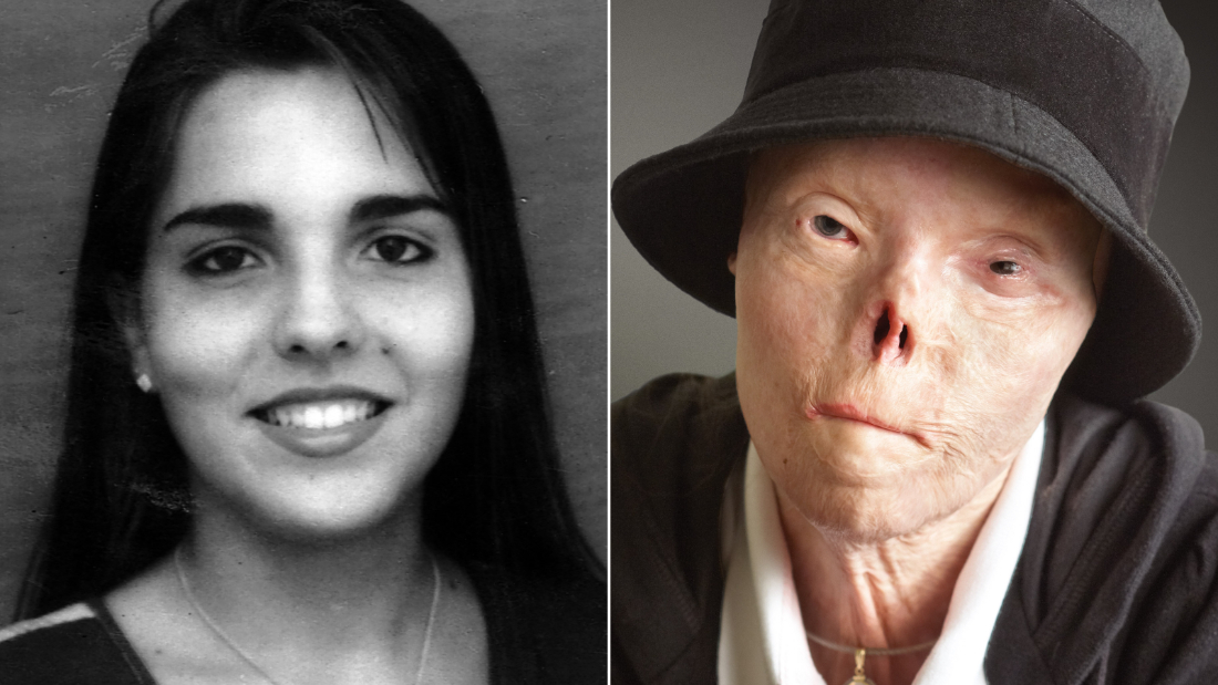 Morreu Jacqui Saburido, a jovem que ficou com 60% do corpo queimado num acidente de viação