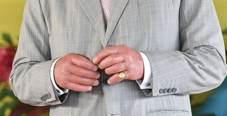 Já reparou nos dedos de salsicha de Carlos III? Médica explica esta doença que envergonha o Rei