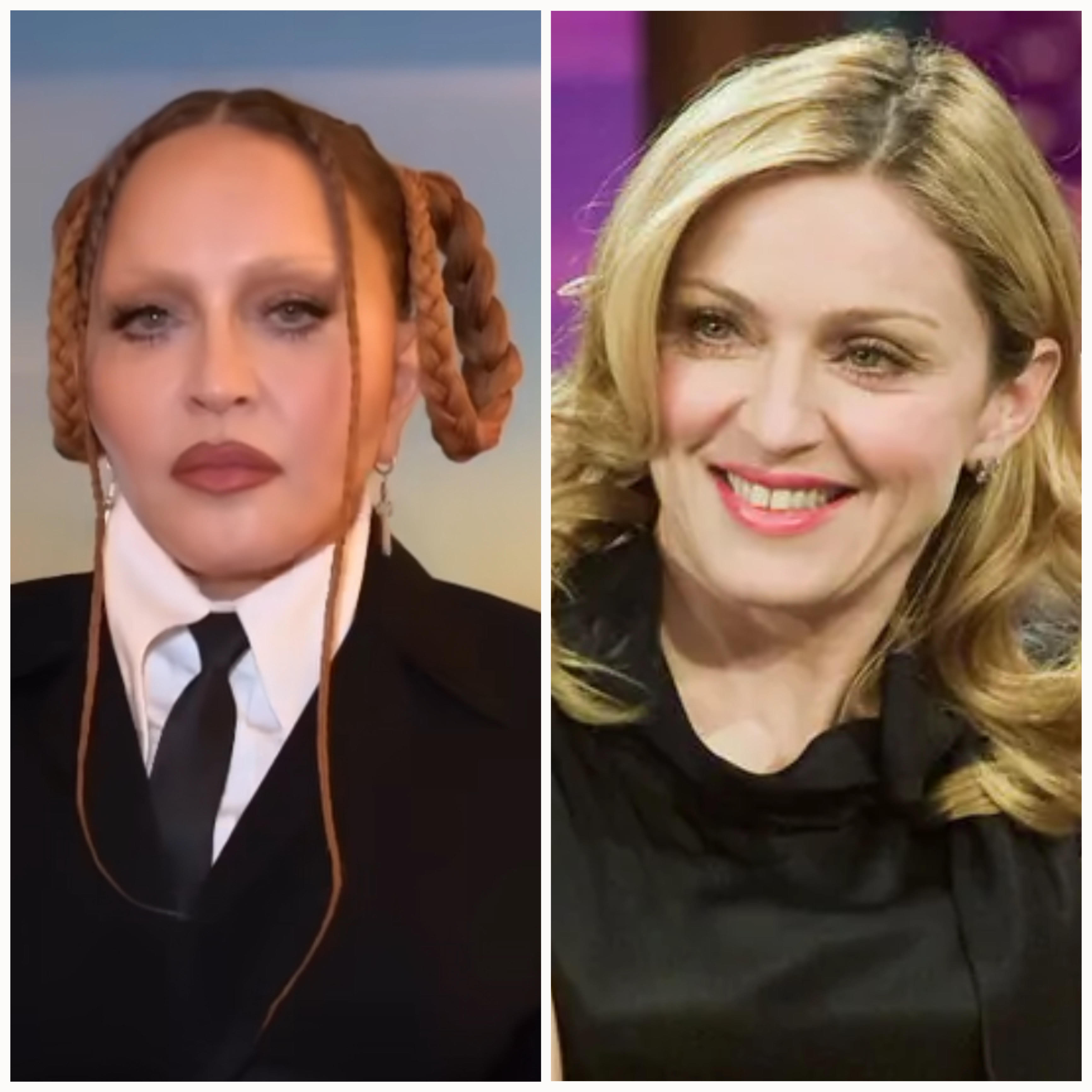 A cara de Madonna está a deixar meio mundo confuso. Especialistas apontam as intervenções estéticas da cantora