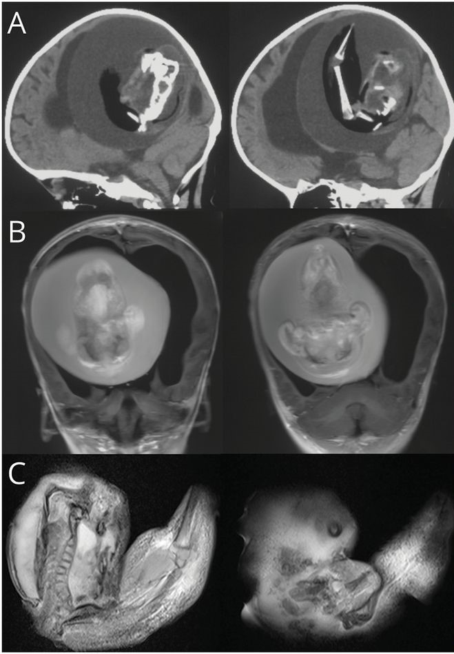 Feto retirado de cérebro de bebé de 1 ano. Menina já apresentava dificuldades motoras