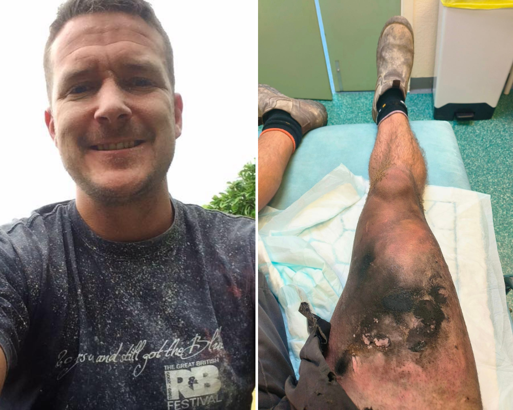 Bateria de vape explode no bolso e deixa homem com queimaduras graves