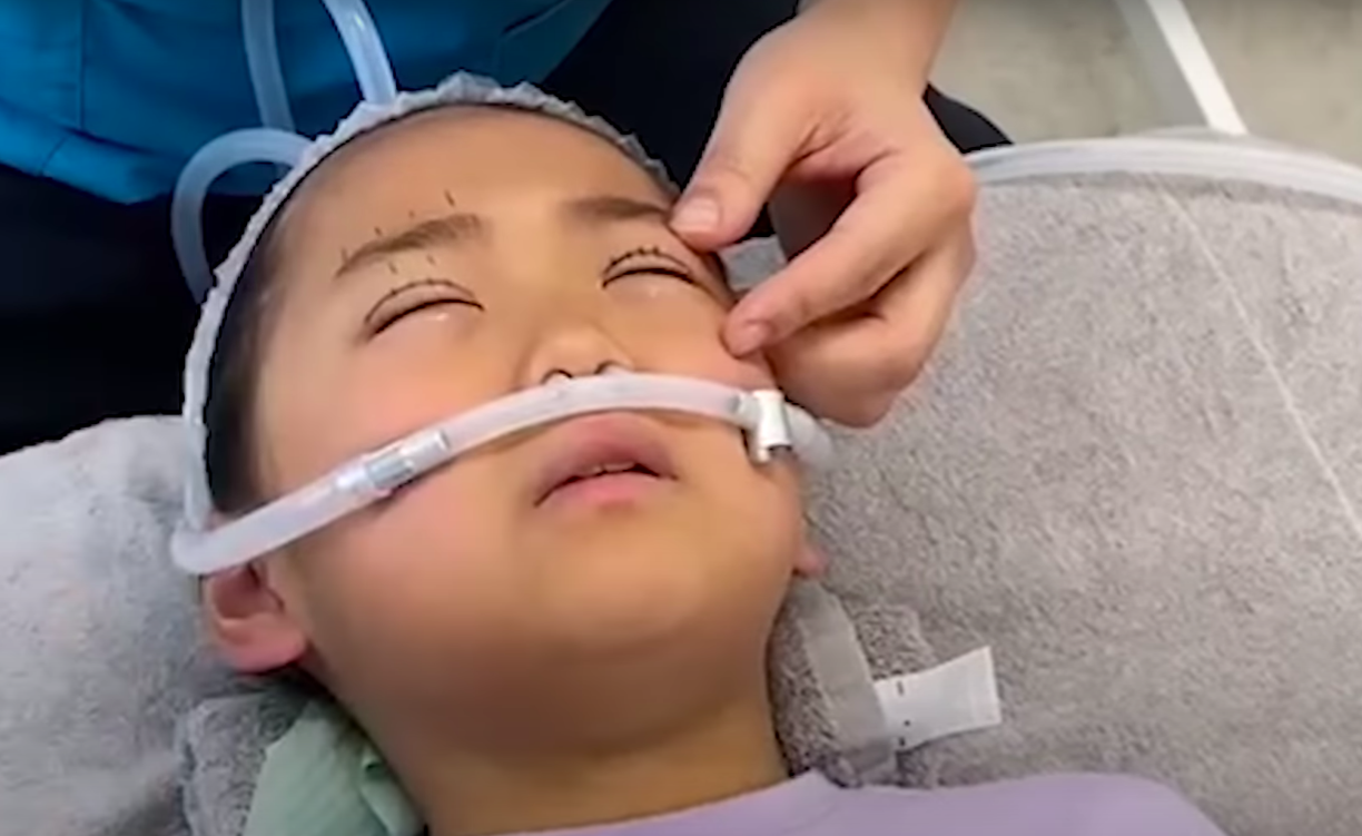 Mãe impõe plástica aos olhos à filha de 9 anos “para ficar bonita”. Operação levou 2 horas e foi sem anestesia