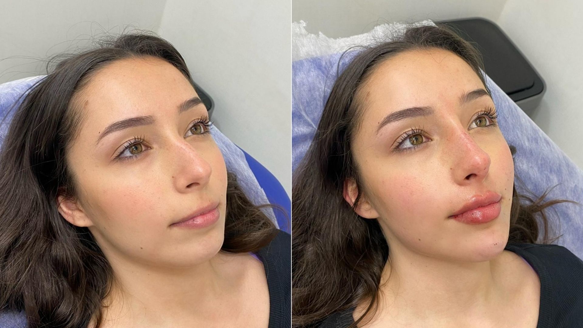 Não doeu e demorou 30 minutos: perdi a “virgindade” das intervenções estéticas