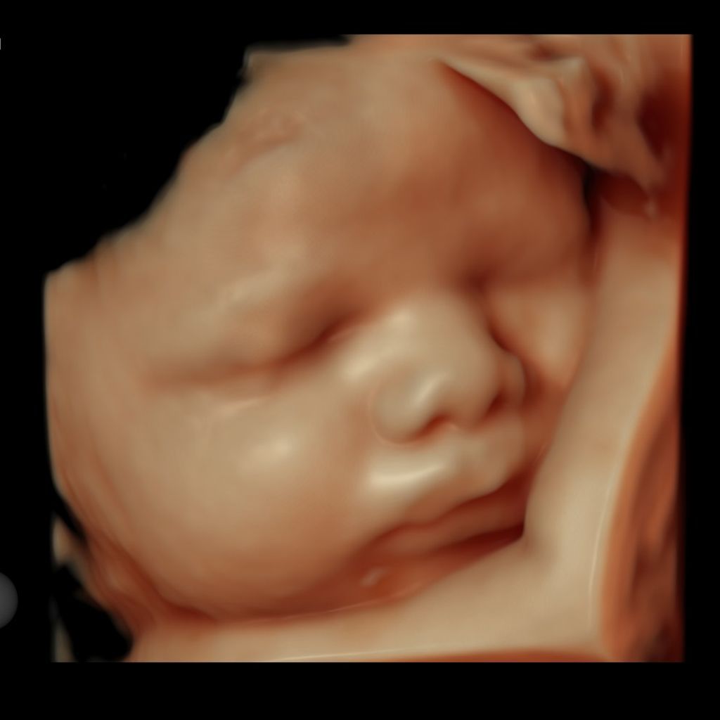 Ecografias 5D. Conhecer o seu filho ainda antes de ele nascer